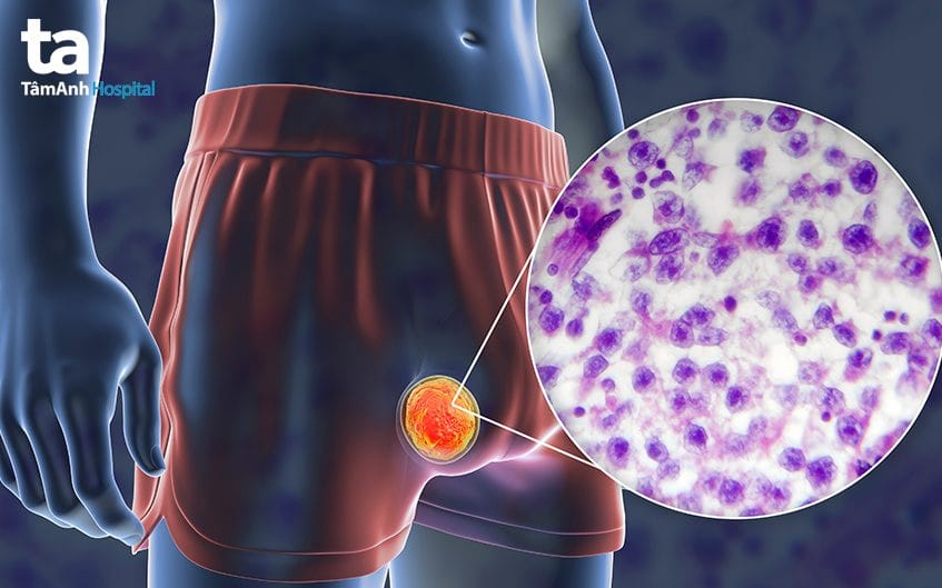 Các yếu tố rủi ro và nguyên nhân dẫn đến bìu bị xệ ở nam giới
