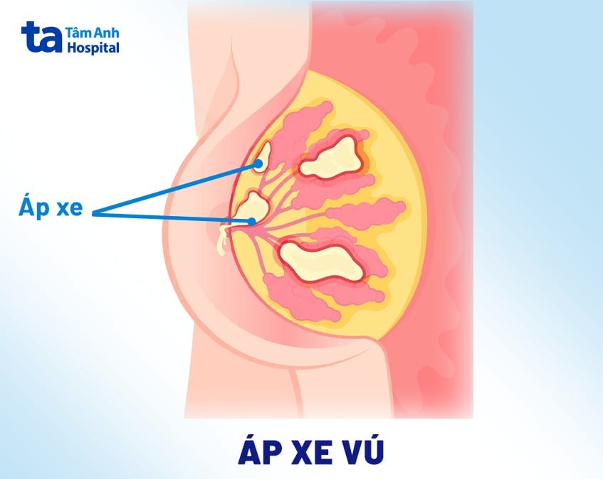 Hình ảnh áp xe vú, thường gặp ở phụ nữ cho con bú, biểu hiện sưng đỏ và đau